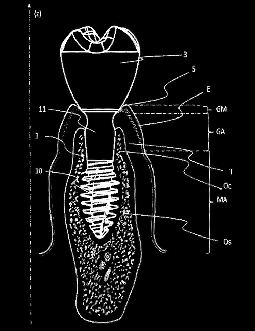 Brevet — implant dentaire